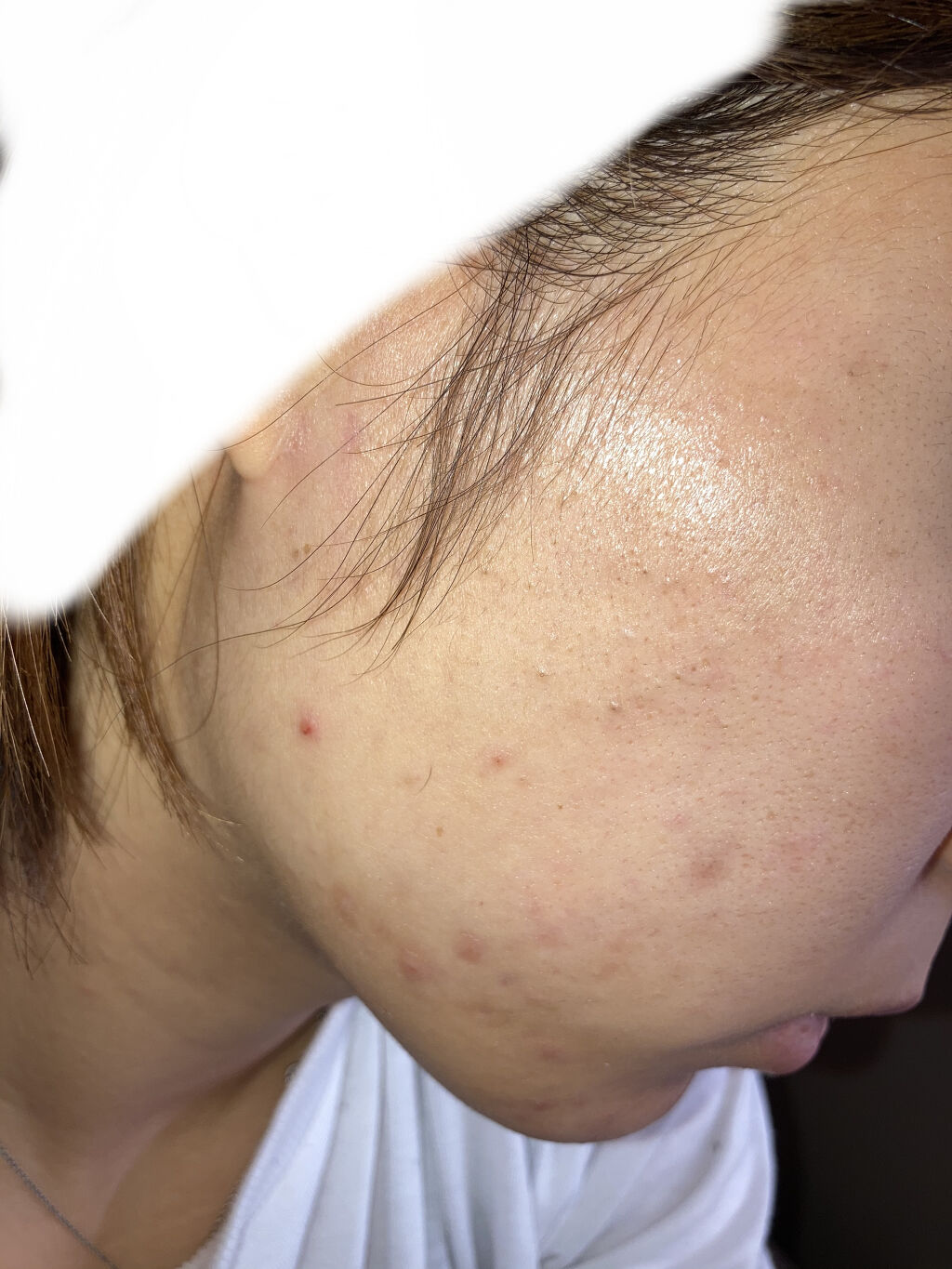 ペアアクネクリームW(医薬品)/ペア/その他を使ったクチコミ（2枚目）