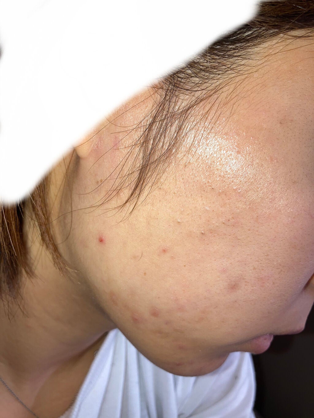 ペアアクネクリームW(医薬品)/ペア/その他を使ったクチコミ(2枚目)