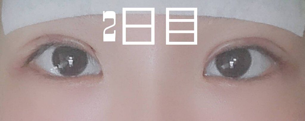 二重整形/その他を使ったクチコミ（2枚目）