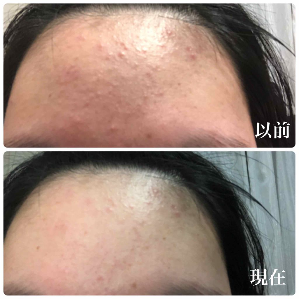 ノブ Ａ アクネソープ/NOV/洗顔石鹸を使ったクチコミ（3枚目）