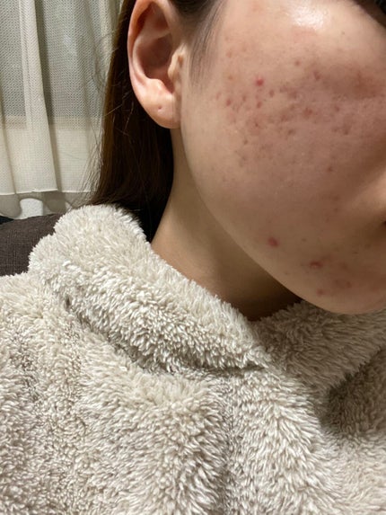 モイスチャー リッチローション(とてもしっとり)/アルージェ/化粧水を使ったクチコミ(2枚目)