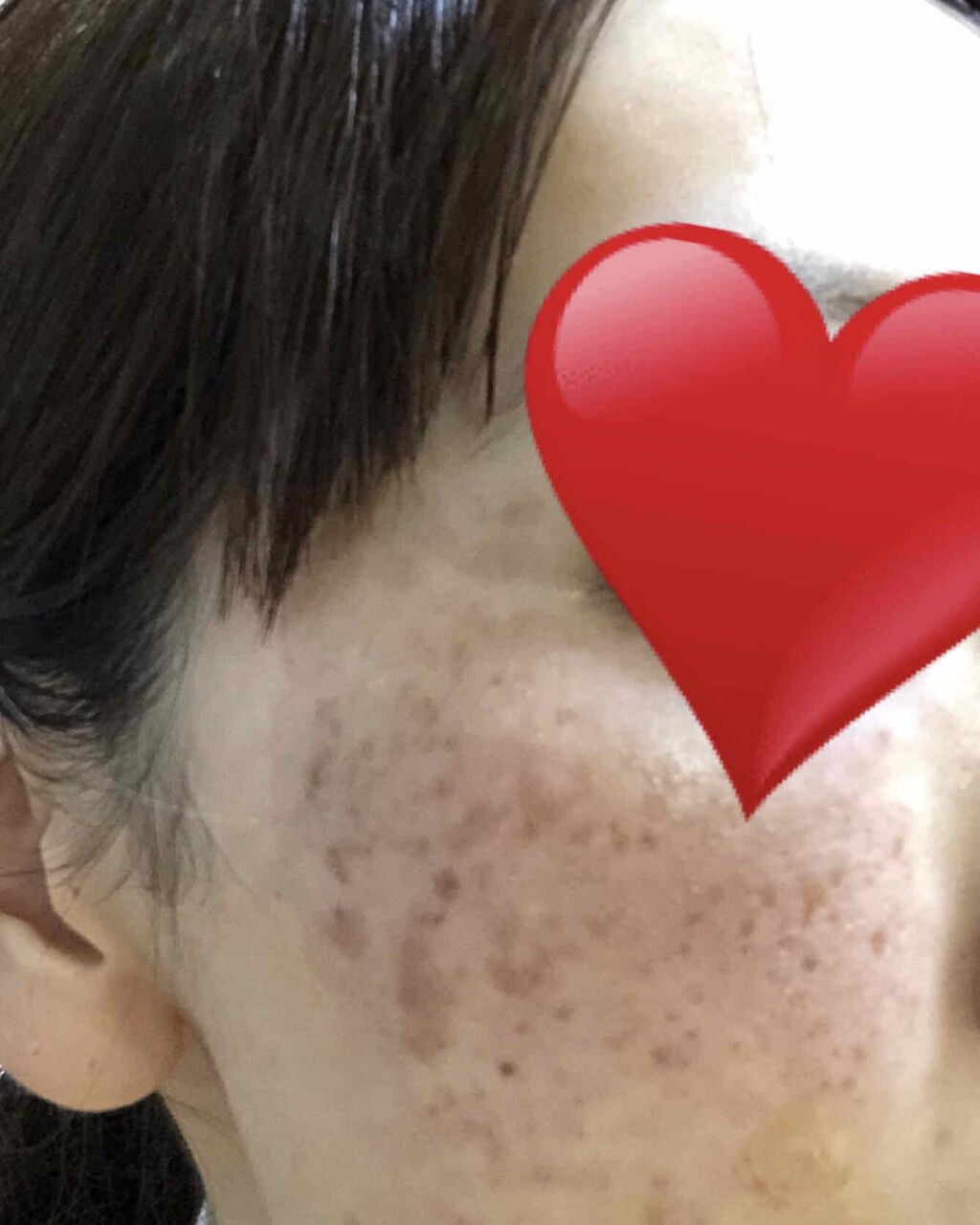 ねこ村 on LIPS 「Qスイッチ・アレキサンドライトレーザーを照射しました。一応全顔..」(3枚目)