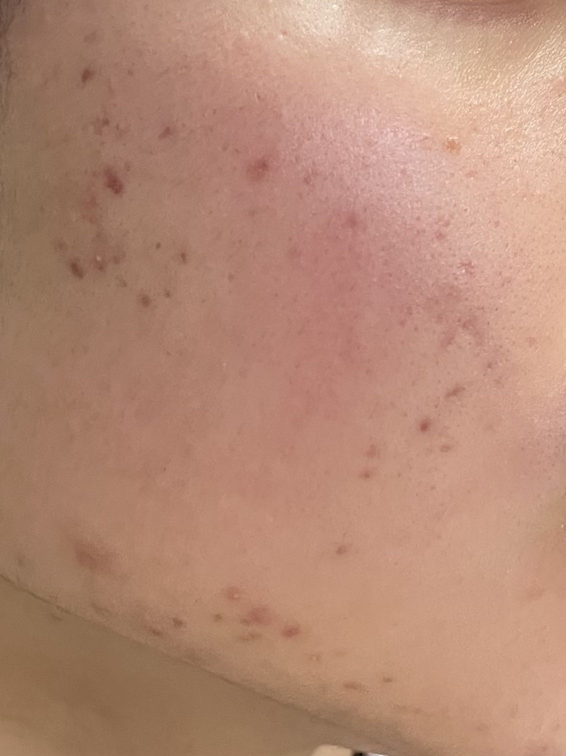 ペアアクネクリームW(医薬品)/ペア/その他を使ったクチコミ（3枚目）