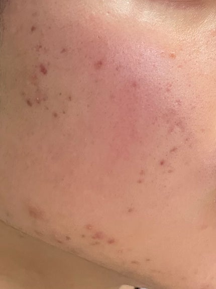 ダーマレーザー スーパーレチノール100マスク/クオリティファースト/シートマスク・パックを使ったクチコミ(3枚目)