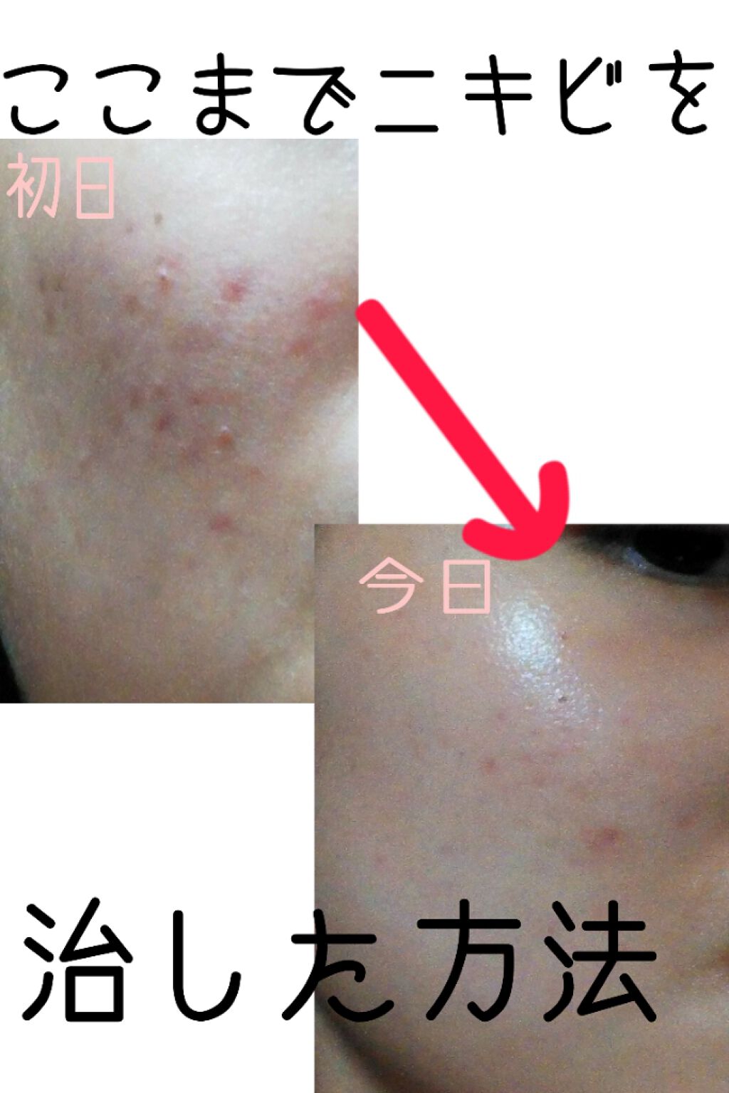 ペアアクネクリームW(医薬品)/ペア/その他を使ったクチコミ（1枚目）