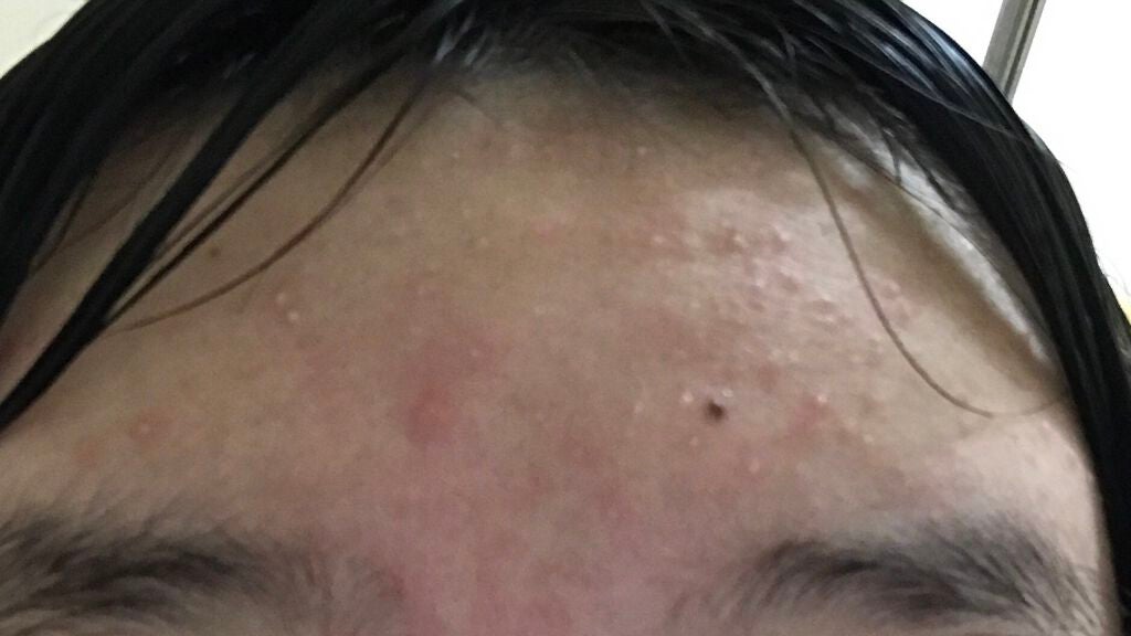 りこ on LIPS 「3日目!スポーツ女子なのでおでこが脂ギッシュになってニキビが増..」(1枚目)