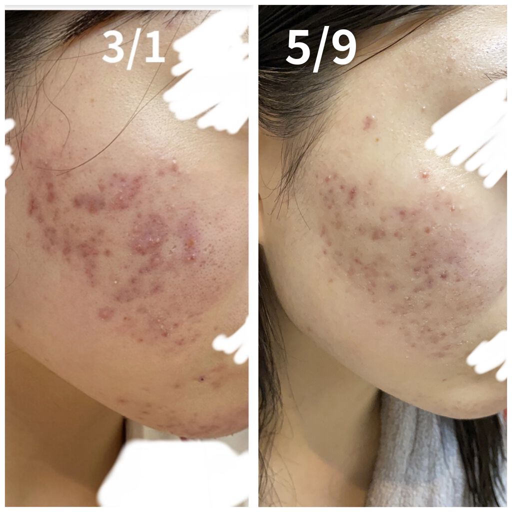 ノブ Ａ アクネソープ/NOV/洗顔石鹸を使ったクチコミ（2枚目）