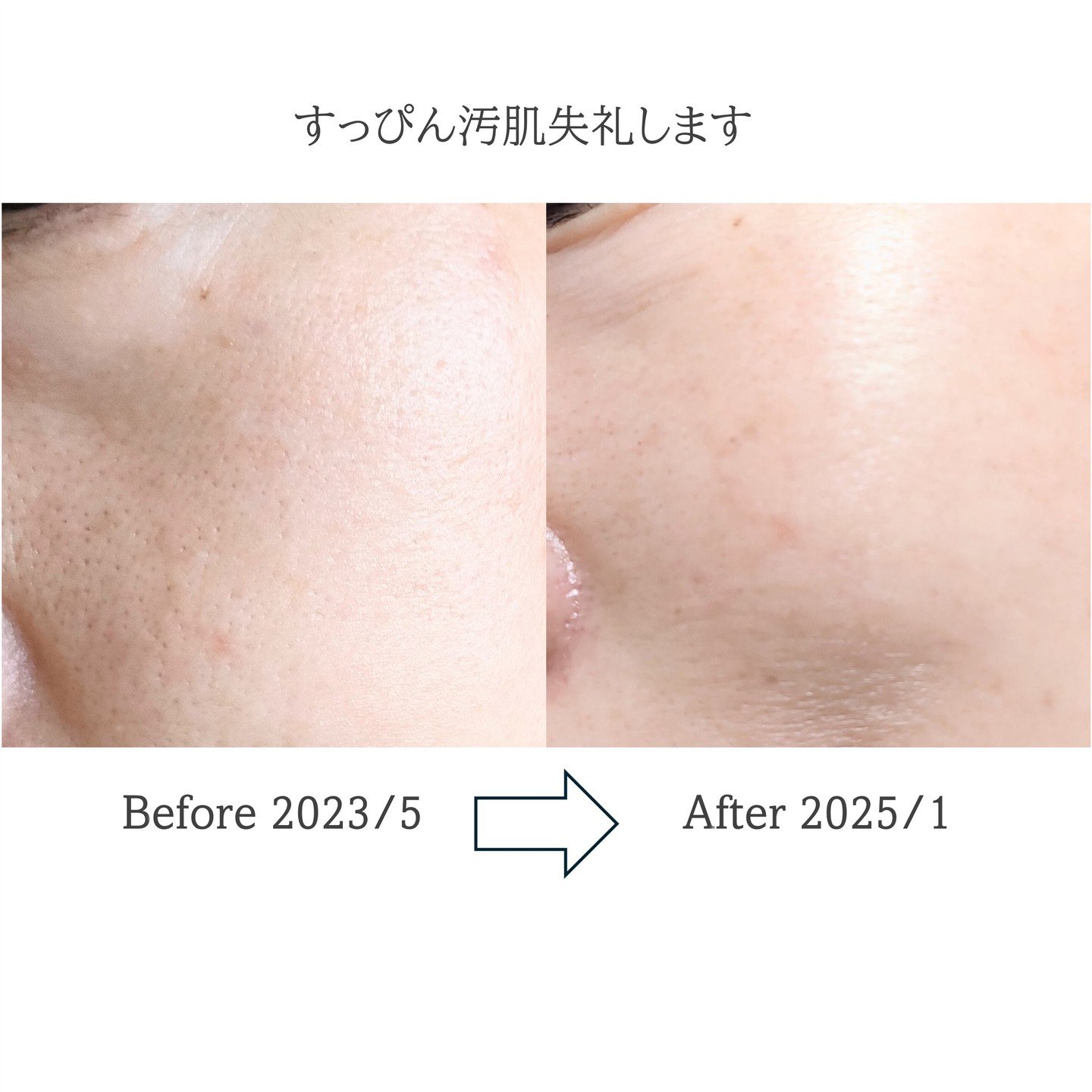 ブラック ヘッド ゼロ ２ステップ ノーズ パッチ/Dr.Althea/シートマスク・パックを使ったクチコミ（1枚目）