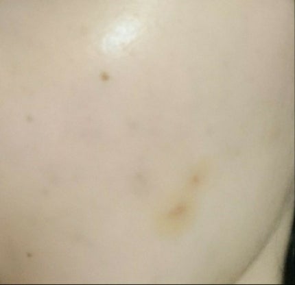 Nexcare/3M nexcare/にきびパッチを使ったクチコミ(2枚目)