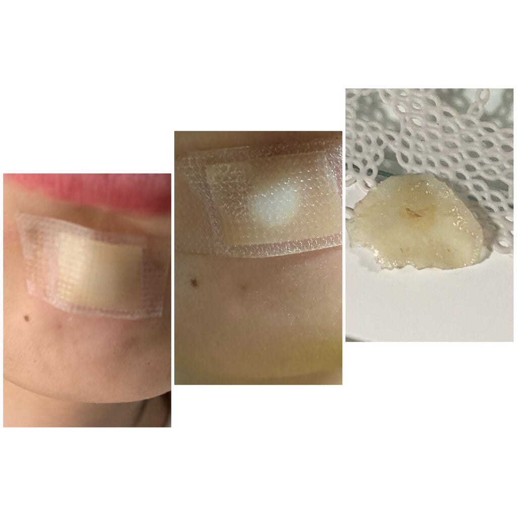 キズパワーパッド/バンドエイド/その他を使ったクチコミ(4枚目)