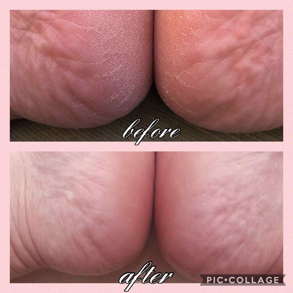 ベルベットスムーズ 電動角質リムーバー ダイヤモンド エキストラ(粗め)/ドクター・ショール/レッグ・フットケアを使ったクチコミ(2枚目)