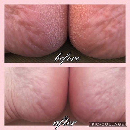 フットモイスチャーパック パープルラベンダー/KOCOSTAR(ココスター)/レッグ・フットケアを使ったクチコミ(2枚目)