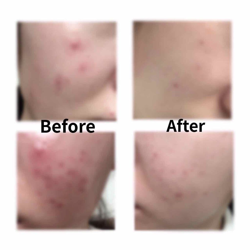 モイスチャー 1セット/エンビロン/トライアルキットを使ったクチコミ（3枚目）