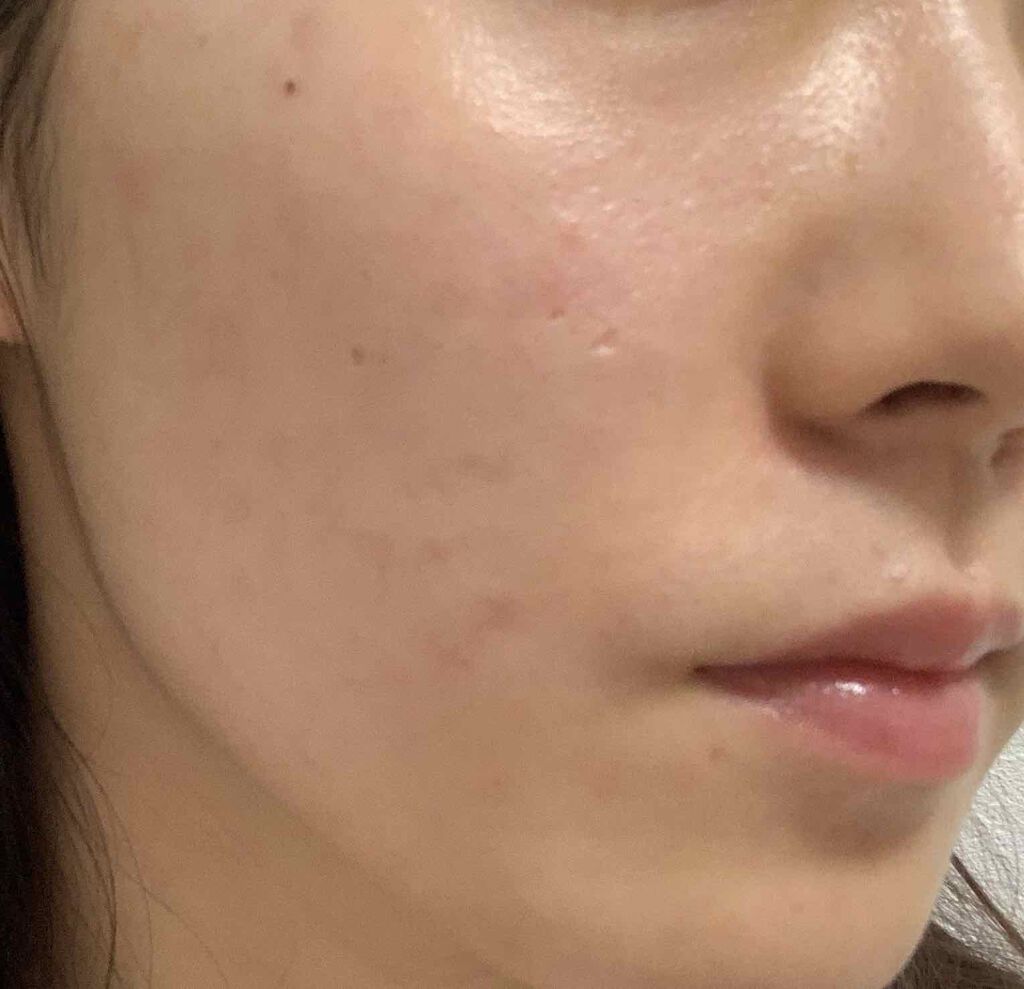 리리나 on LIPS 「こんばんは、리리나です👻2枚目から肌の写真です📷苦手な方は1枚..」(3枚目)