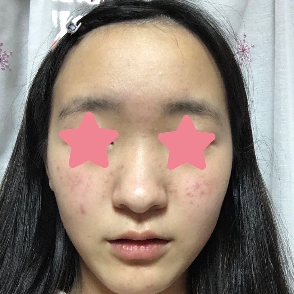 コスメ好きな妹 on LIPS 「おはようございます!こんにちは!こんばんは〜!!今回は私のニキ..」(2枚目)