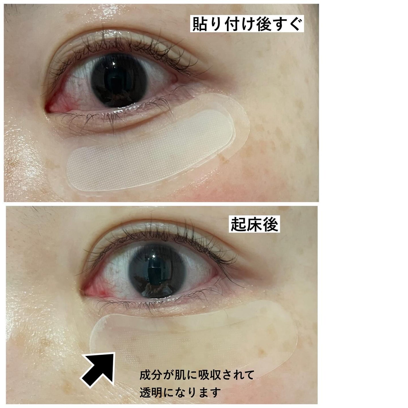 マイクロニードルモイスチャーパッチ/a little/シートマスク・パックを使ったクチコミ(5枚目)