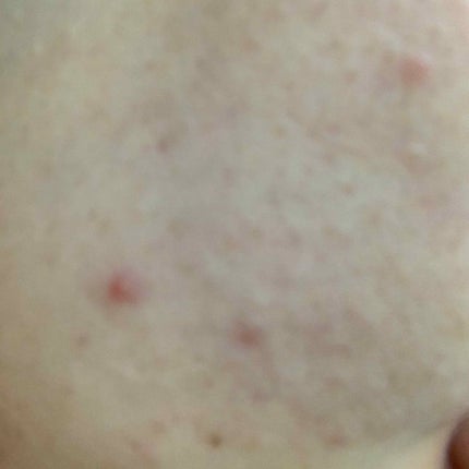 sou on LIPS 「ニキビができることがストレス...はやく良くなって欲しいです😣..」(2枚目)