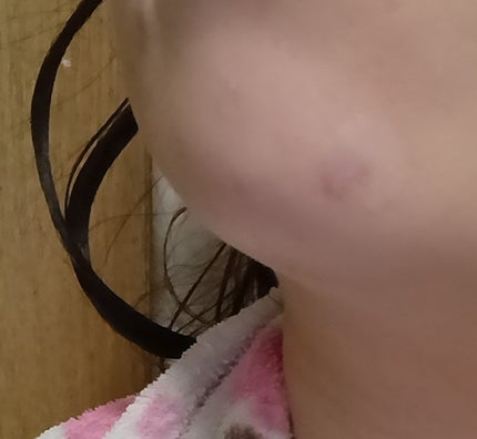 極薄透明パッチ nikipa!/金冠堂/にきびパッチを使ったクチコミ(3枚目)