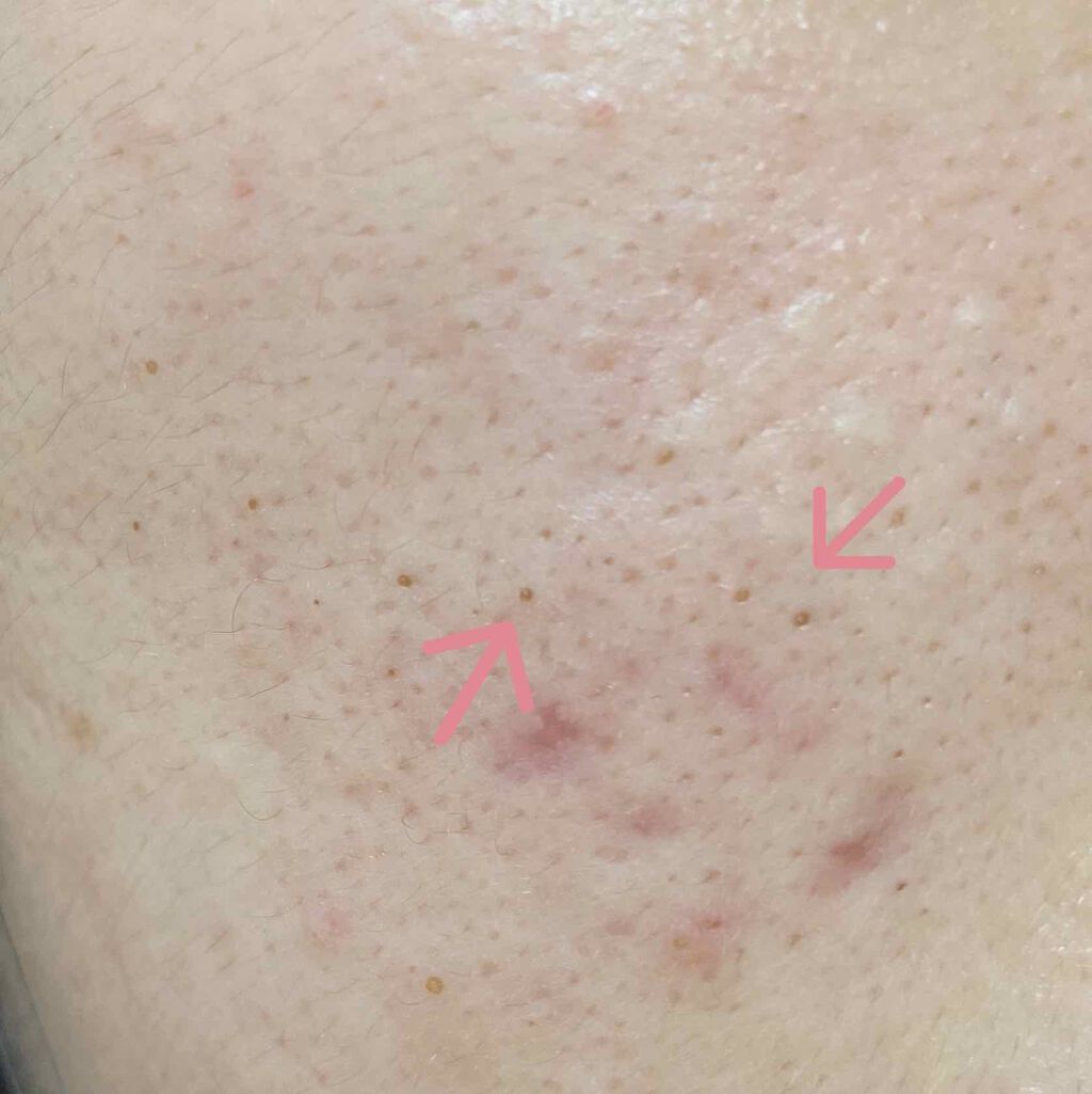 マシュマロメンタル on LIPS 「⚠️2枚目汚肌とおります⚠️閲覧ありがとうございナマステ🤲🏻こ..」(3枚目)