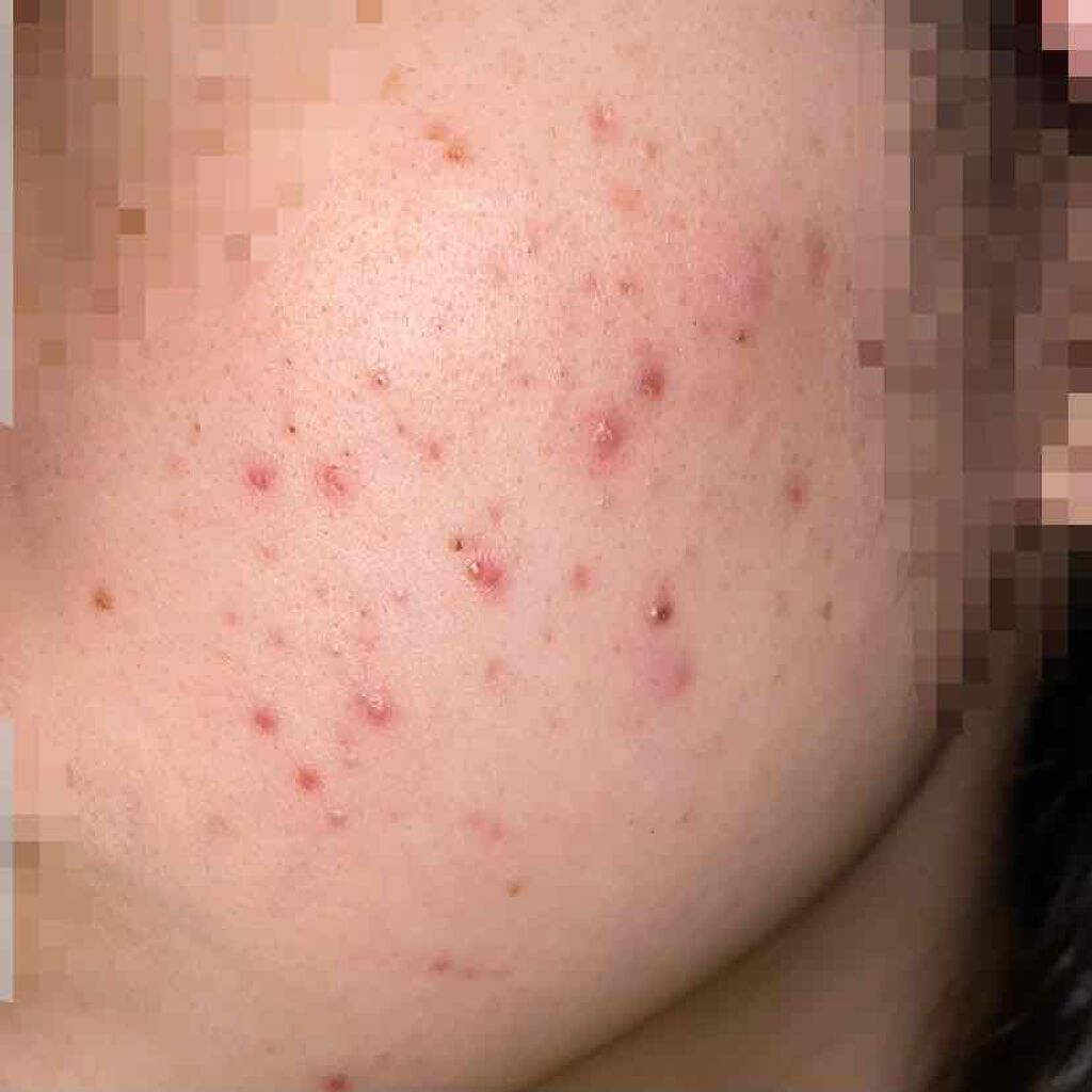 オキシドール(医薬品)/日本薬局方/その他を使ったクチコミ(3枚目)