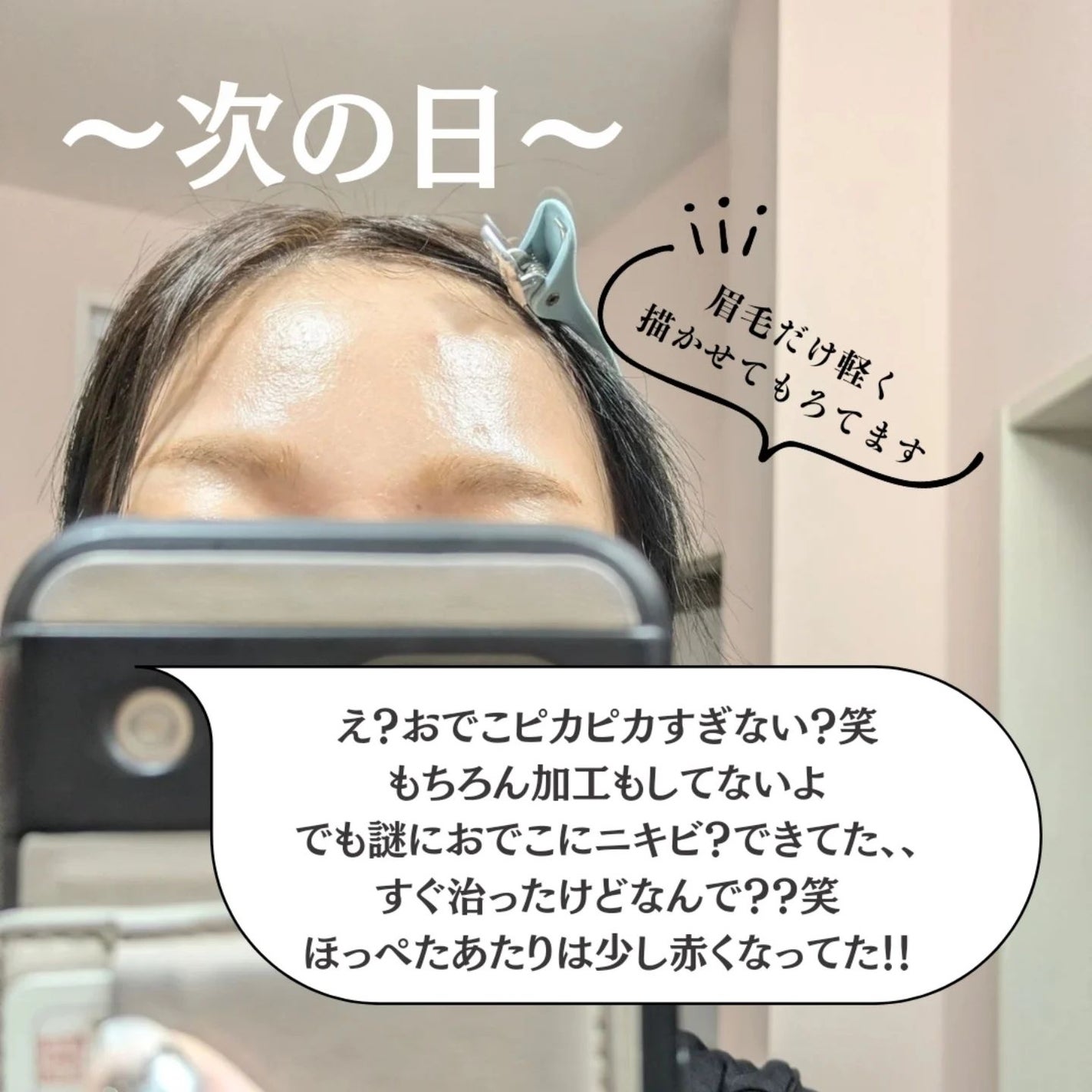 ダーマスキンピーリング/BQCELL/その他キットセットを使ったクチコミ(5枚目)