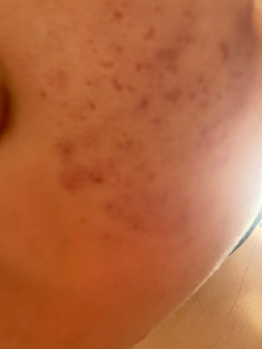 うみ on LIPS 「ニキビ跡の治し方教えてください#はじめての投稿..」(3枚目)