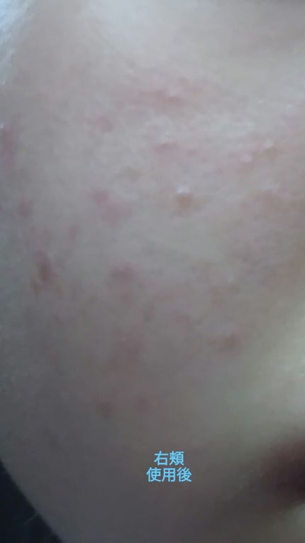 ティーツリーケアソリューション アンプルマスクJEX/MEDIHEAL/シートマスク・パックを使ったクチコミ(5枚目)