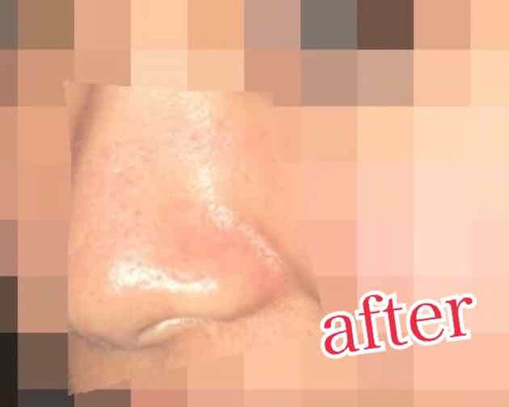 薬用アクネ ポアケアローション(ミスト)/ettusais/ミスト状化粧水を使ったクチコミ(4枚目)