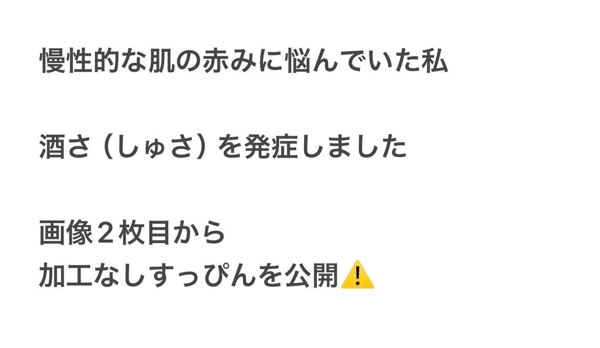 Mikaringo on LIPS 「元々肌が白かったのもあり日焼けをすると赤くなったり痒みが出たり..」(1枚目)