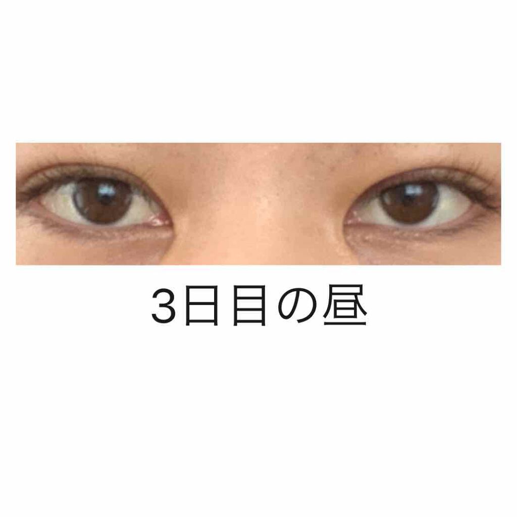 かっこいい女になりたいんだ on LIPS 「3日目の朝と昼朝起きた時は目の腫れはあまり変わりない、、違和感..」(2枚目)