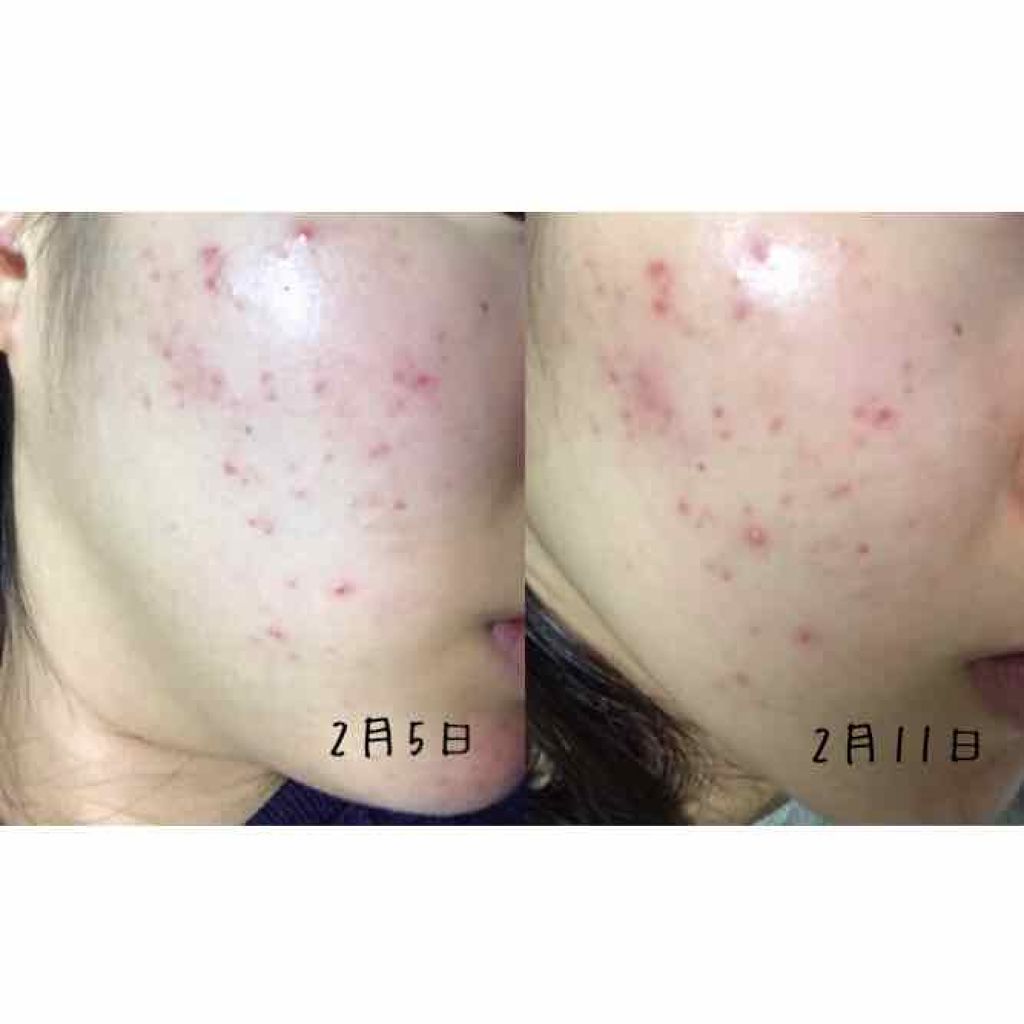 DHC ビタミンBミックス/DHC/美容サプリメントを使ったクチコミ（2枚目）