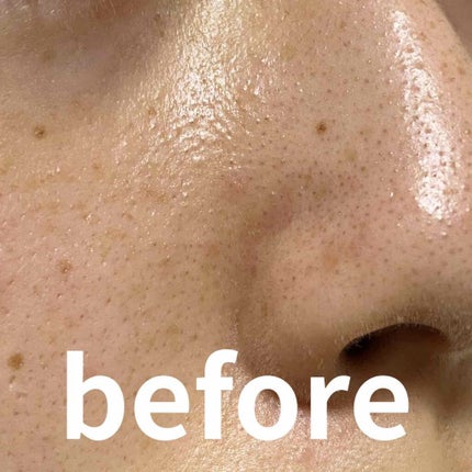 光美容器KE-NON(ケノン)/エムテック/家庭用脱毛器を使ったクチコミ(2枚目)