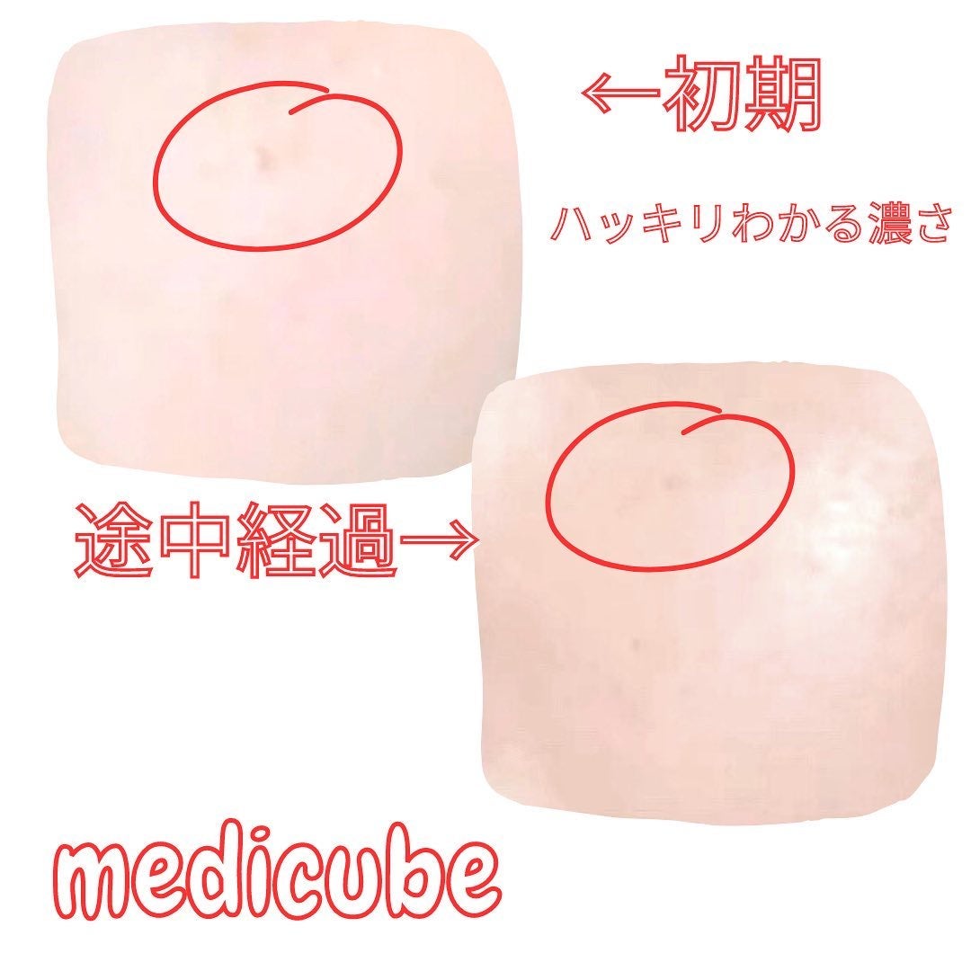 レッドアクネピーリングセラム/MEDICUBE/美容液を使ったクチコミ(5枚目)