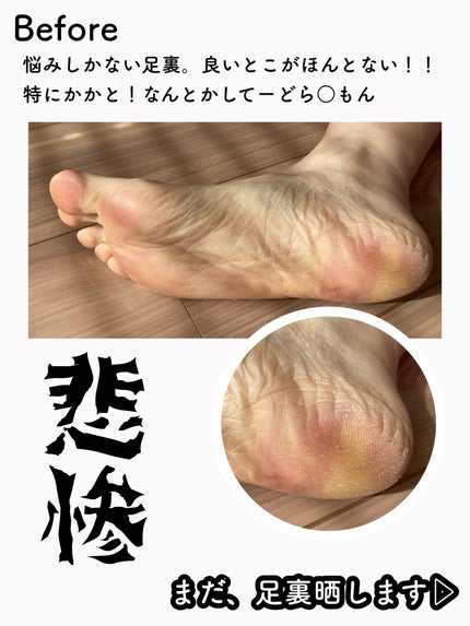 イージーパックDP60分タイプ/ベビーフット/レッグ・フットケアを使ったクチコミ(6枚目)