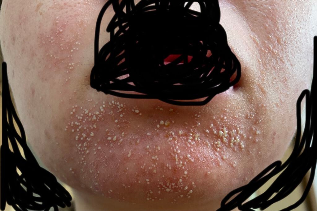 じんじゃー🫚 on LIPS 「2枚目、閲覧注意です合わない基礎化粧品でとんでもない事になって..」(2枚目)