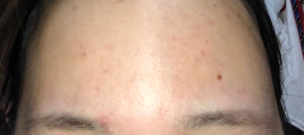 いずみ on LIPS 「どうか助けてください…🥺🙏ニキビとニキビ跡が酷くて、毎日鏡を見..」(3枚目)