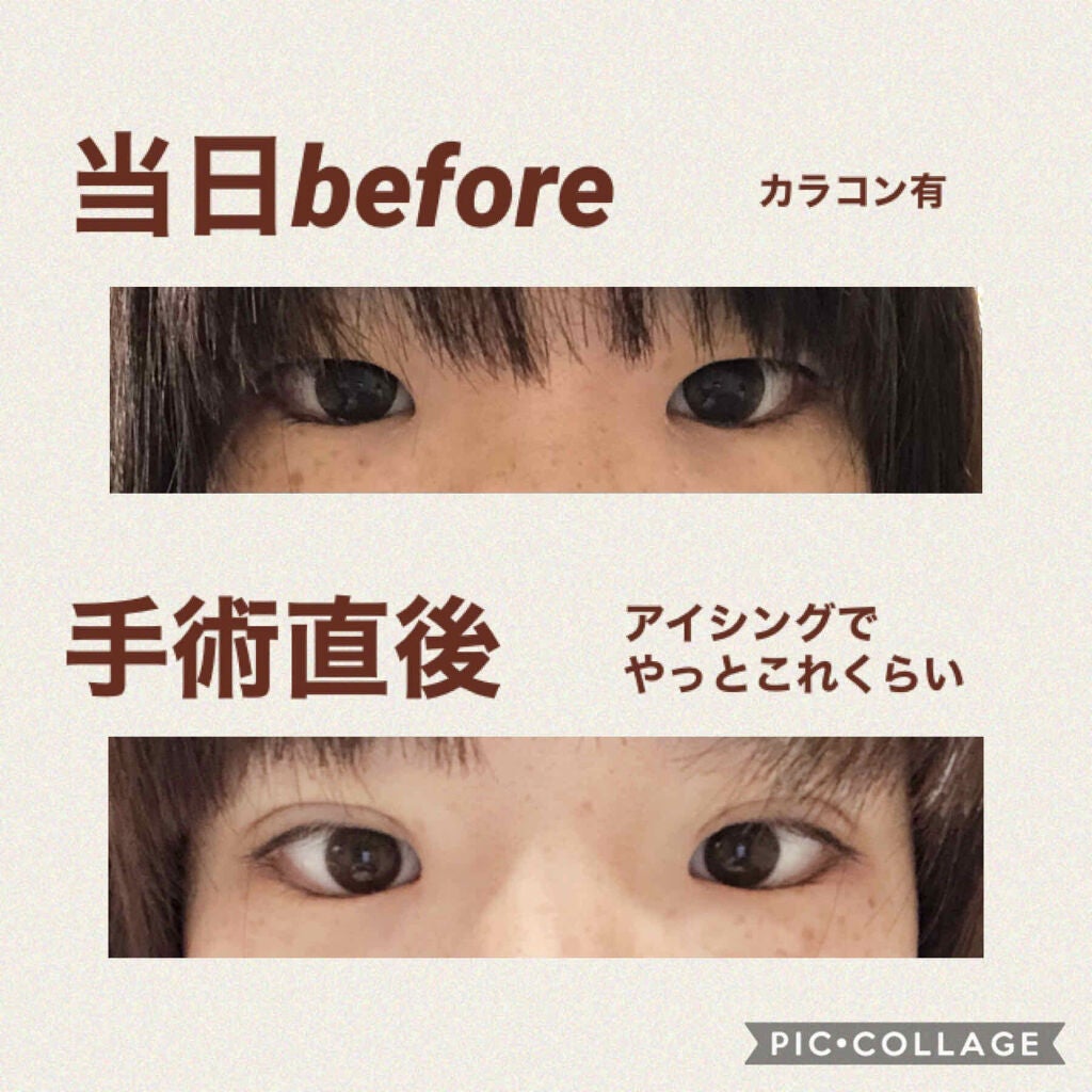 ぬこた on LIPS 「埋没直後湘南のクイックコスメティークダブル。笑気麻酔効きすぎて..」(2枚目)