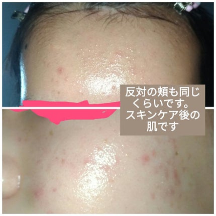 ヒルセリンクリーム/コジット/フェイスクリームを使ったクチコミ(2枚目)