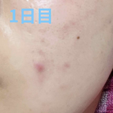 ダラシンTゲル 1% (医薬品)/佐藤製薬/その他を使ったクチコミ(2枚目)