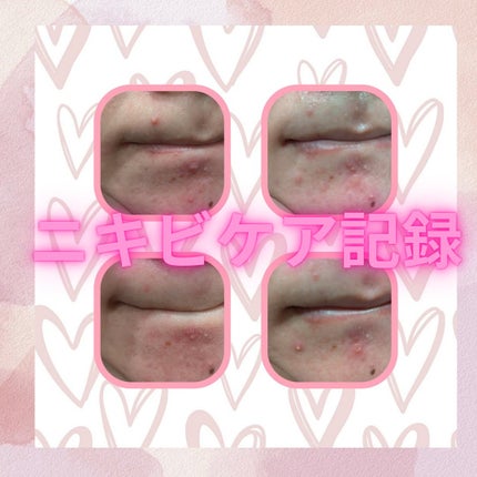 WHITEA PREMIUM(医薬品)/ハイチオール/その他を使ったクチコミ(1枚目)