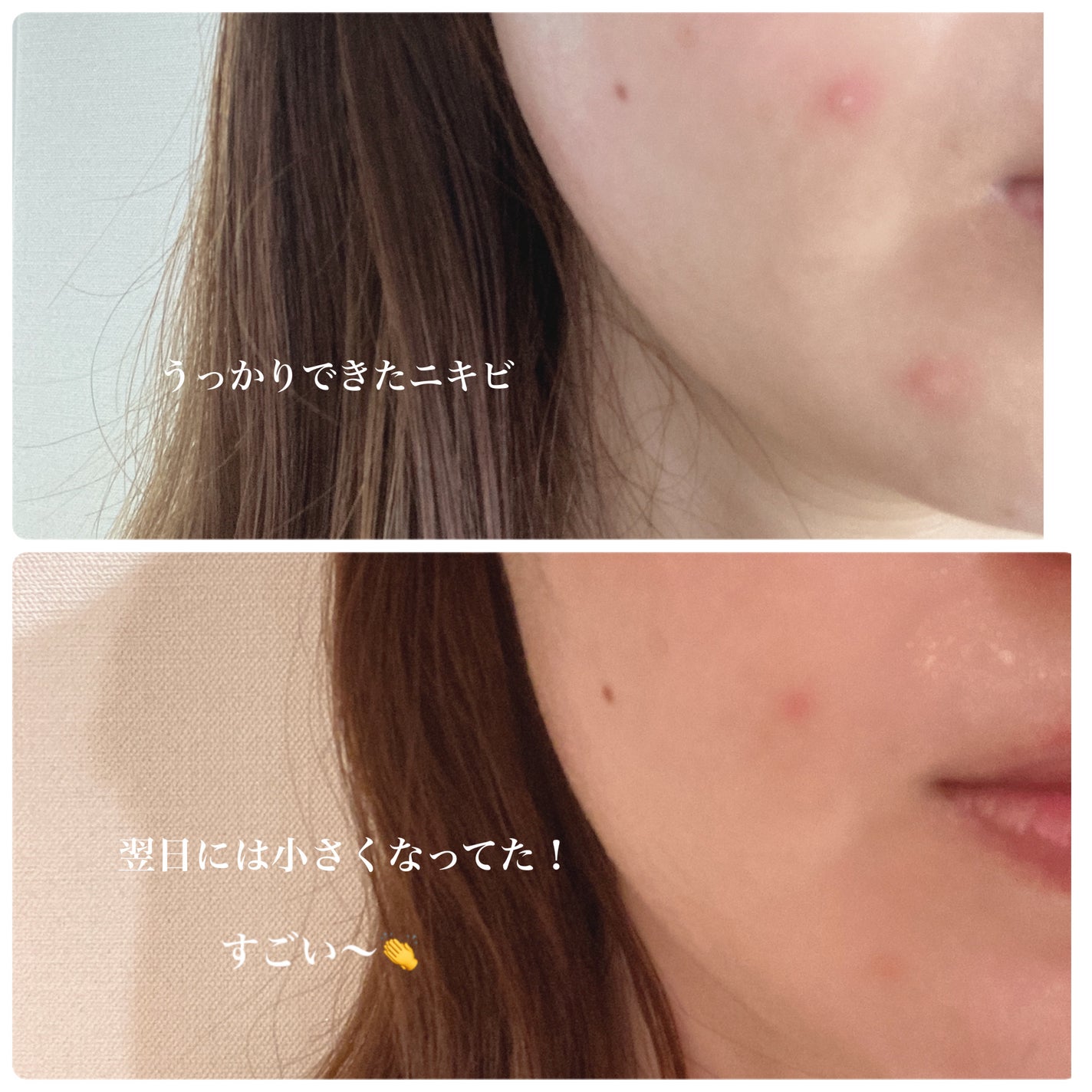 スキンピールバー ティートゥリー/サンソリット/洗顔石鹸を使ったクチコミ(9枚目)