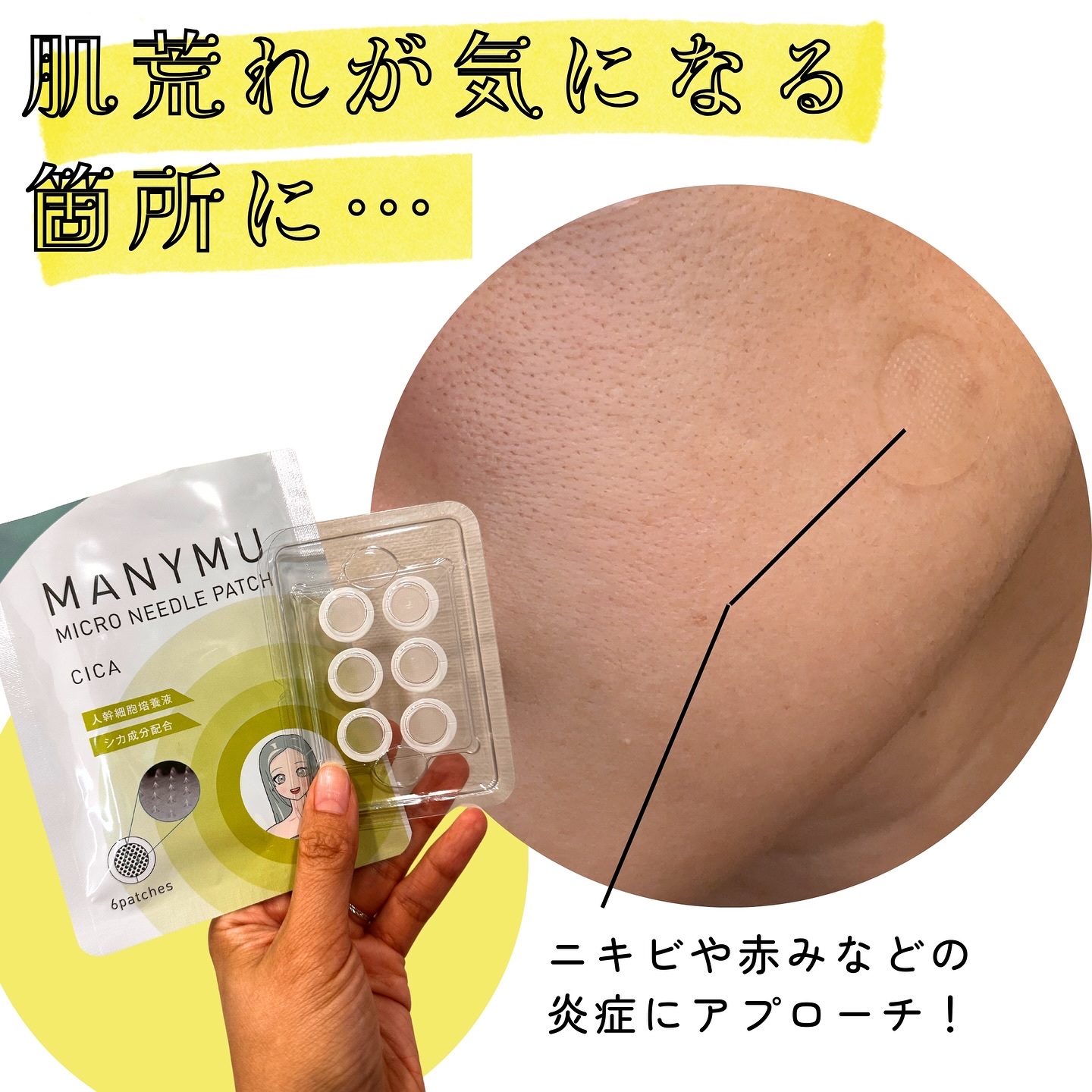 マイクロニードルパッチ シカ/MANYMU/シートマスク・パックを使ったクチコミ（2枚目）