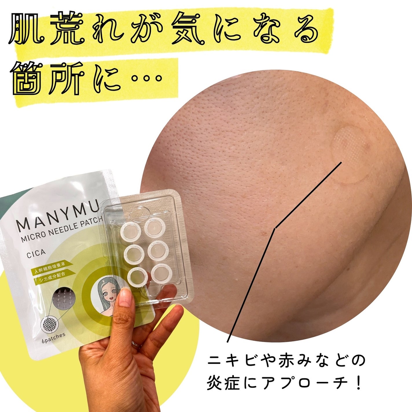 マイクロニードルパッチ シカ/MANYMU/シートマスク・パックを使ったクチコミ(2枚目)