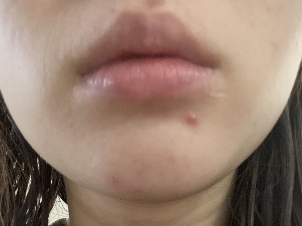 ドルマイコーチ軟膏(医薬品)/ゼリア新薬工業/その他を使ったクチコミ（1枚目）