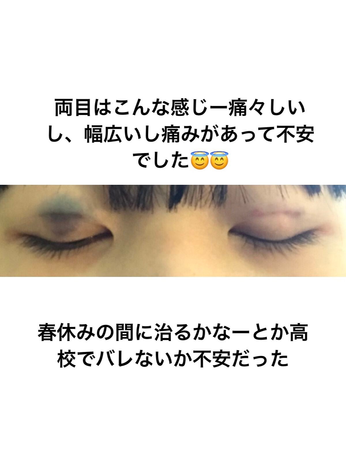 べあ@sjk on LIPS 「春休み真っ只中、整形シーズン!ということで普段投稿あまりしない..」(6枚目)