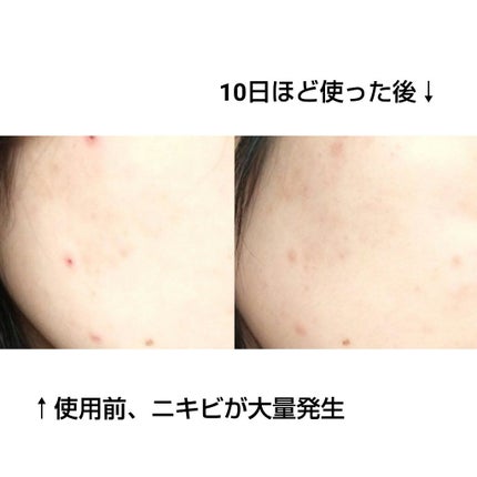 薬用 しみ 集中対策 美容液/メラノCC/美容液を使ったクチコミ(3枚目)