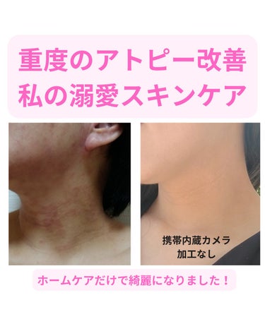 美肌カウンセラー💆綺麗のお助け相談所 on LIPS 「元重度のアトピーから誉められ艶肌への変貌🍀効果が実感できた３つ..」（1枚目）