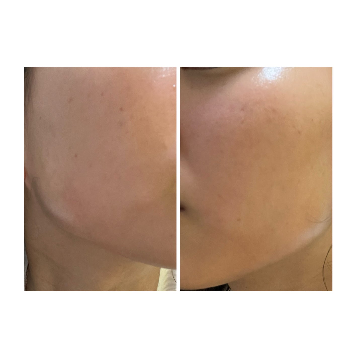 ぽむ on LIPS 「2023.9.13皮膚科に受診 エピデュオとヘパリン処方1枚目..」(1枚目)