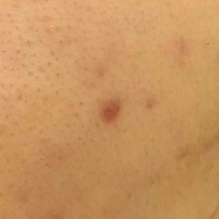 薬用 しみ 集中対策 美容液/メラノCC/美容液を使ったクチコミ(2枚目)