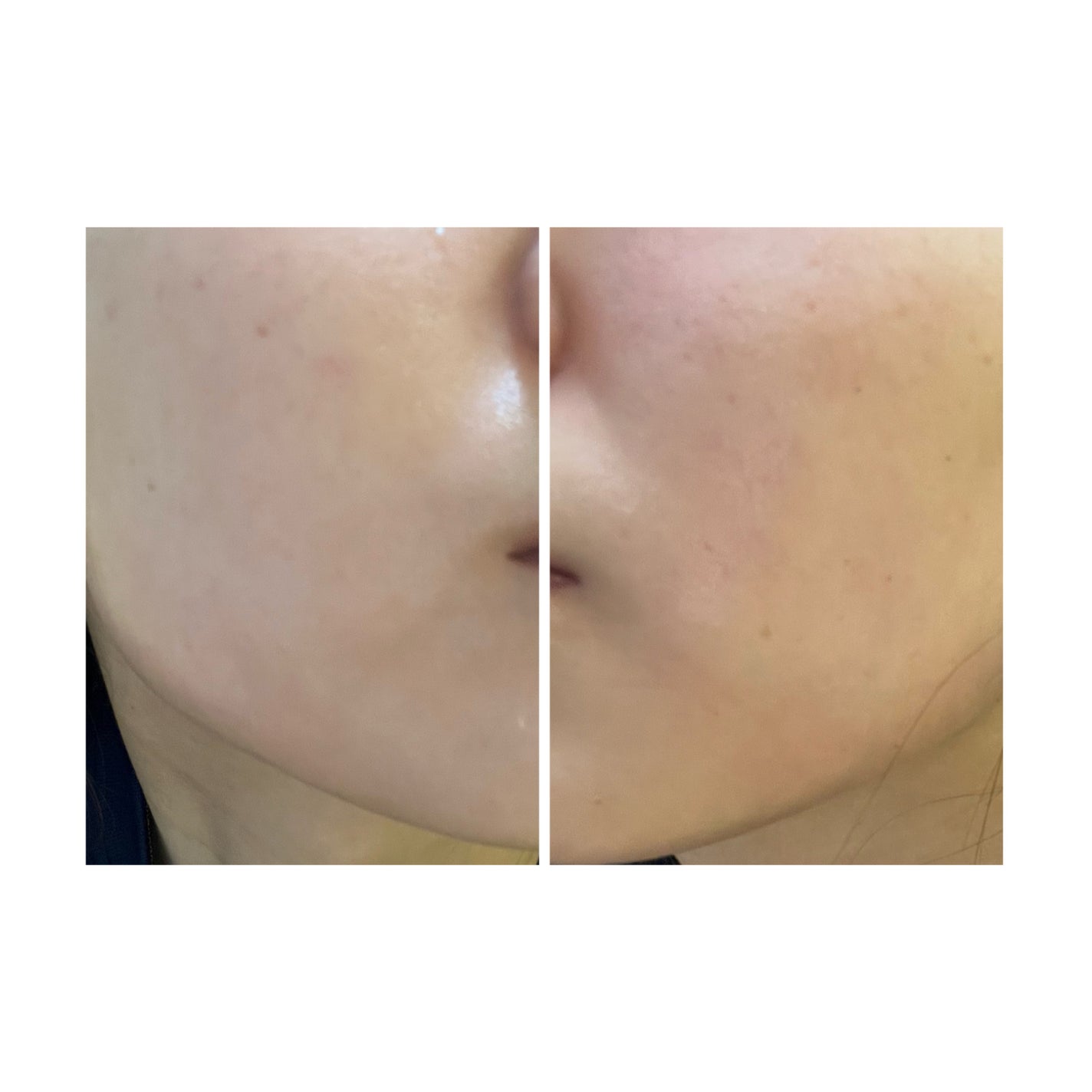 ぽむ on LIPS 「2023.9.13皮膚科に受診 エピデュオとヘパリン処方1枚目..」(2枚目)